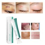 Scar Removal & Repair Cream for Smooth, Clear Complexion