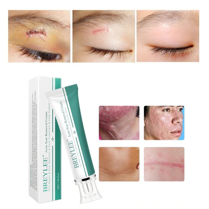 Scar Removal & Repair Cream for Smooth, Clear Complexion