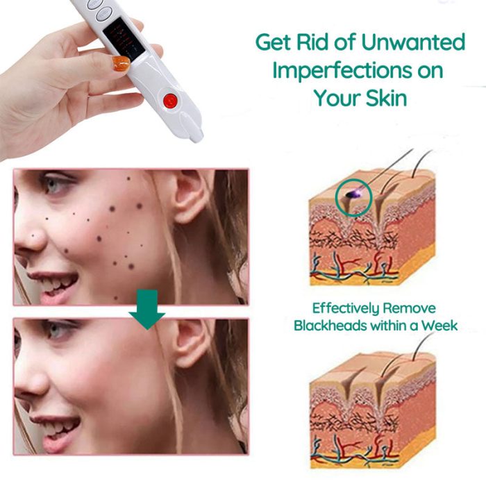 2 in 1 Dot Removal Pen for Removing Tattoos, Freckles, Skin Stains, Wrinkles, Plasma Pen For Skin Tags, Moles, Warts And Tattoos