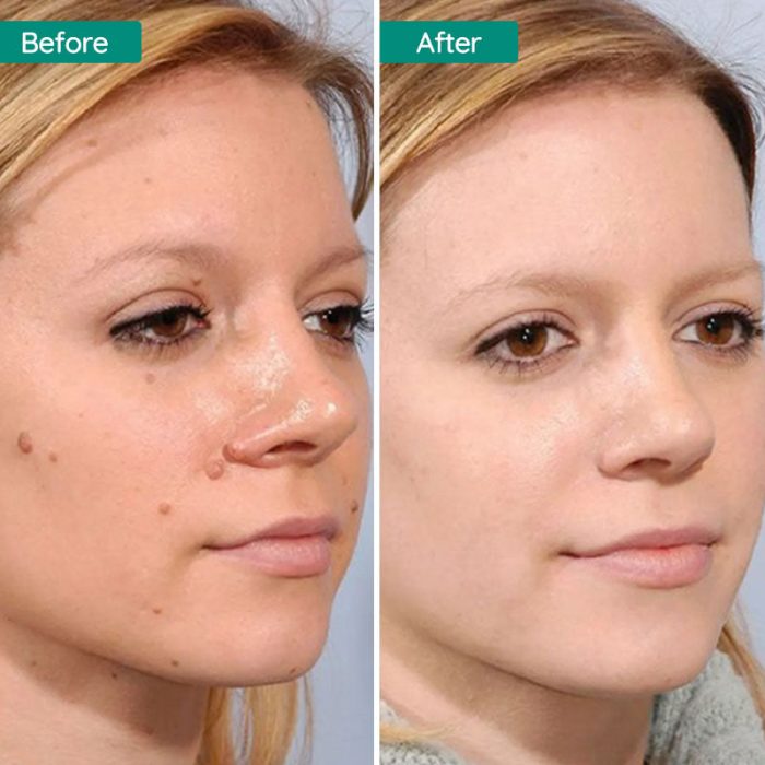 2 in 1 Dot Removal Pen for Removing Tattoos, Freckles, Skin Stains, Wrinkles, Plasma Pen For Skin Tags, Moles, Warts And Tattoos